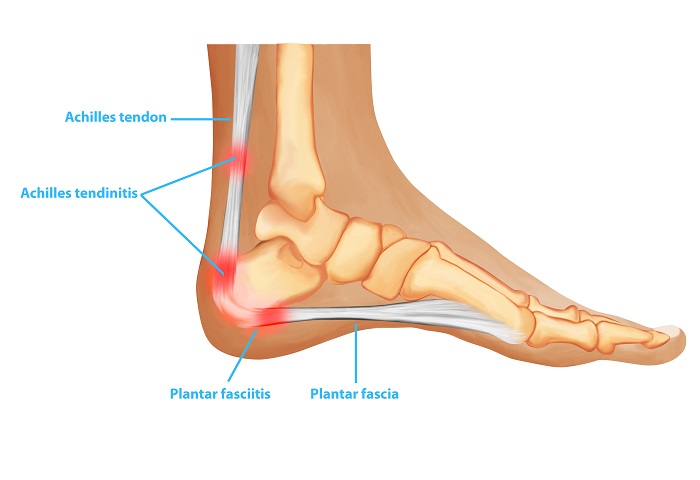 How to Treat Heel, Ankle Pain at Home. Some Easy and Effective Ways - News18-totobed.com.vn